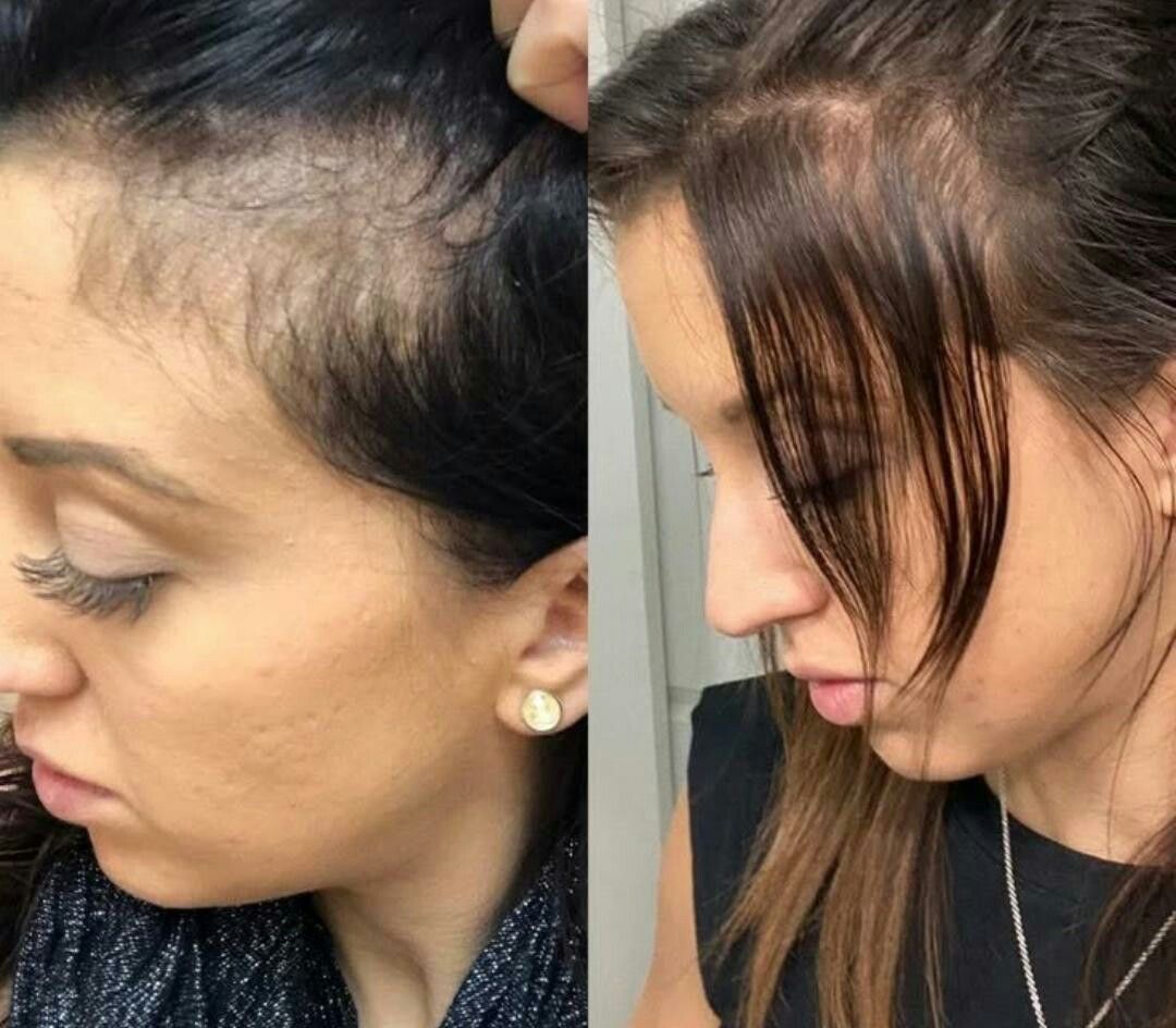 Alopecia Areata Before After Results in Nagpur