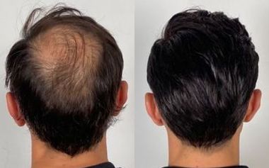 Hair Transplant Before After Results in Nagpur
