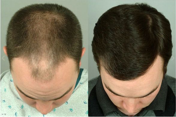 PRP Hair Regrowth Before After Results in Nagpur