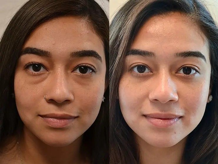 Tear Trough Treatment Before and After Results in Nagpur