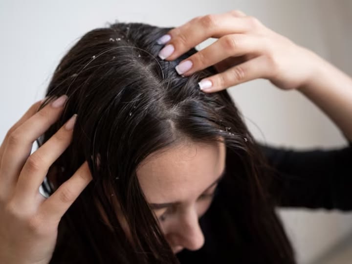 Dandruff Treatment